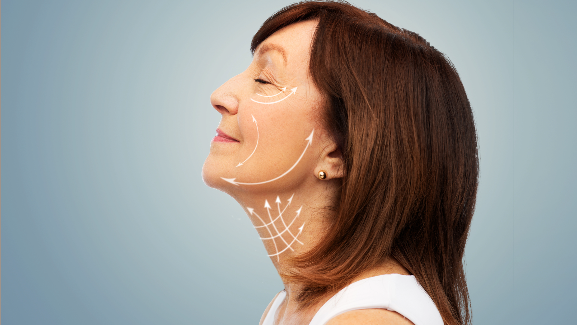 Profile view of a woman with cosmetic arrows indicating facial and neck lifting regions.