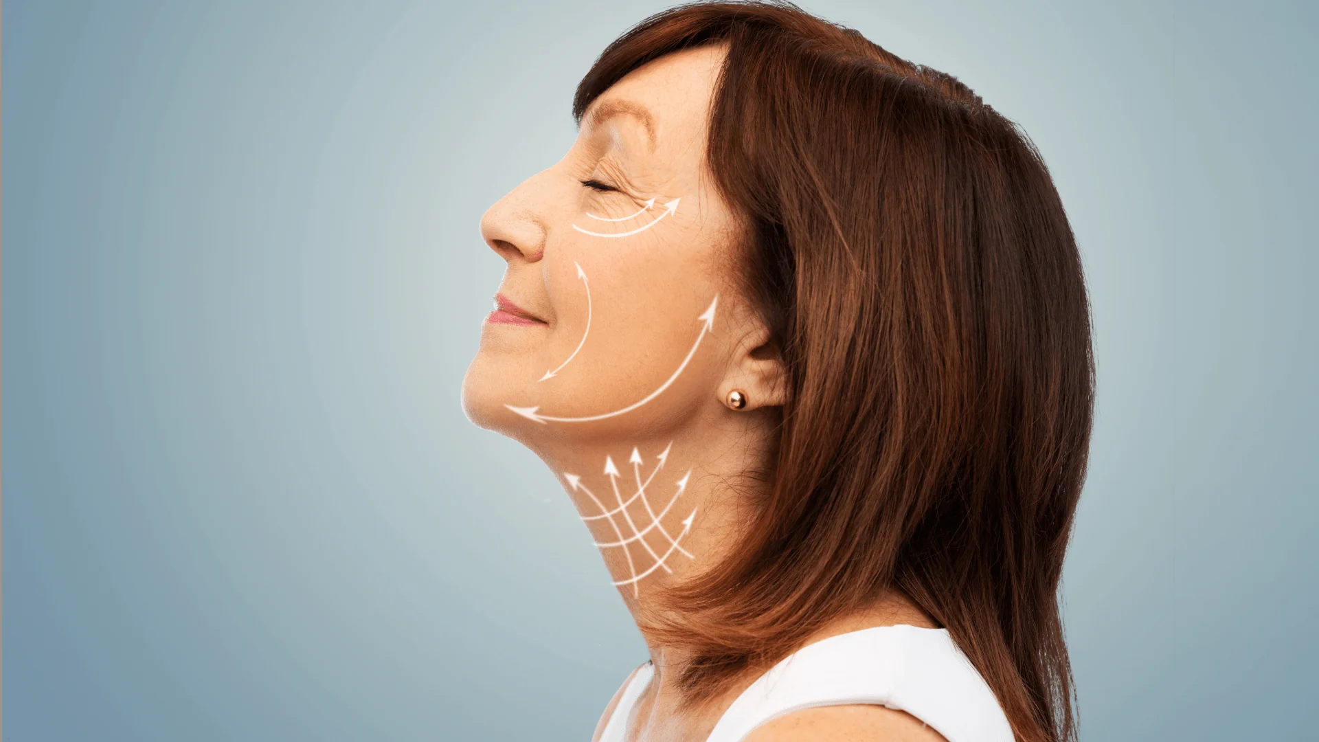 Profile view of a woman with cosmetic arrows indicating facial and neck lifting regions.
