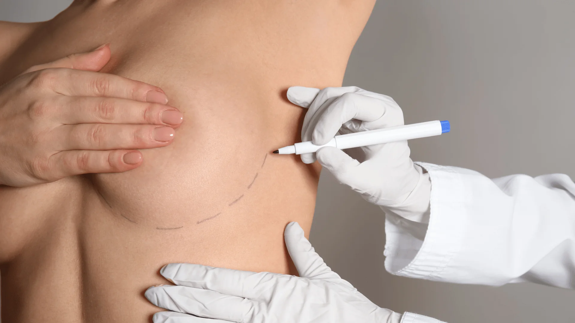 Unbenannt - 14 März 2026 um 115707-1-7 - Dr. Pumberger Close-up of a clinician marking a curved incision line on a patient's neck with a marker while wearing gloves.