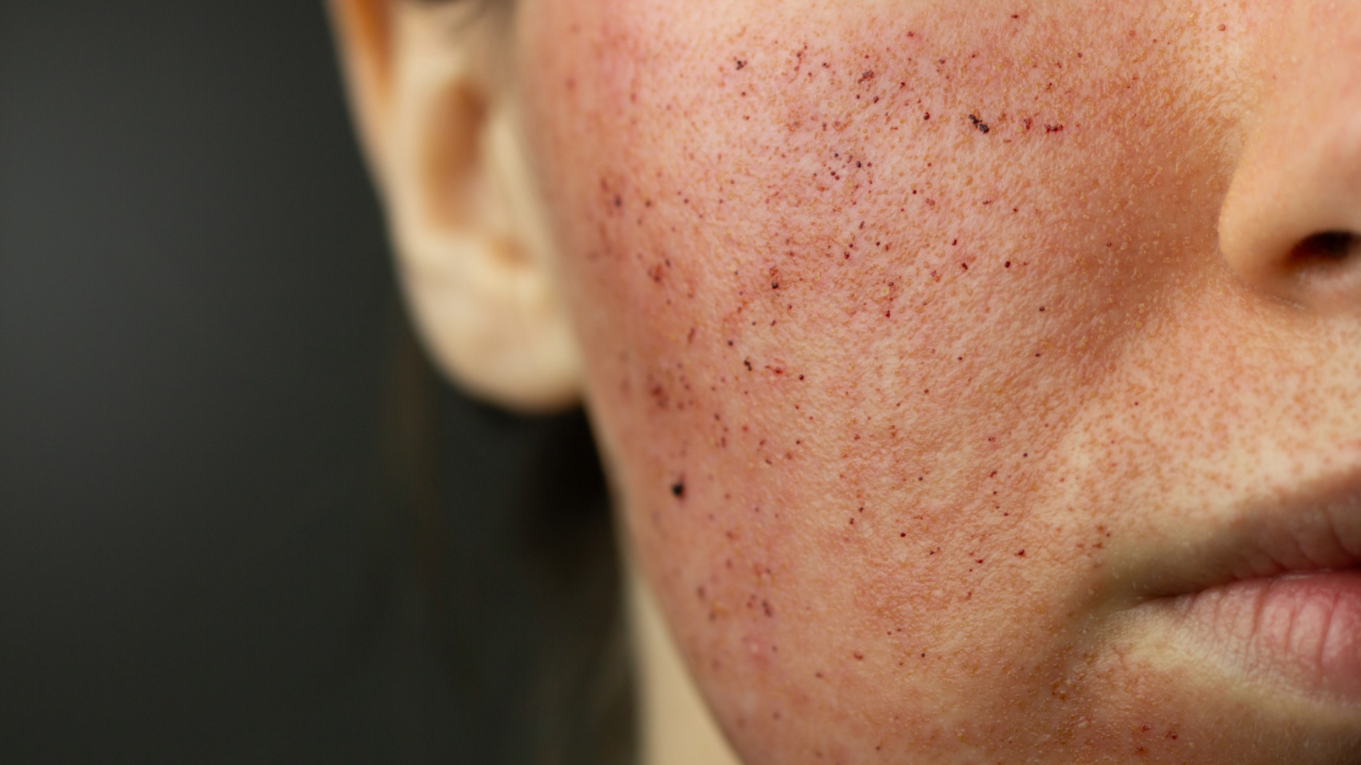Close-up of a cheek with acne-prone skin showing small red blemishes and numerous dark blackheads near the mouth area.
